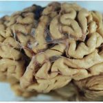 Alzheimer-bakteri-beyin