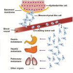 kanser-metastaz