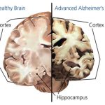 Alzheimers Brain