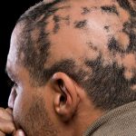 alopecia