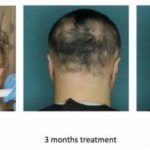 alopecia-areata