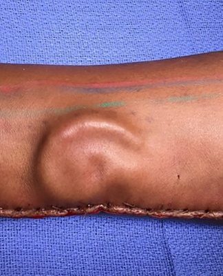 Kolda Yetiştirilen Gerçek Kulak Kafaya Nakledildi