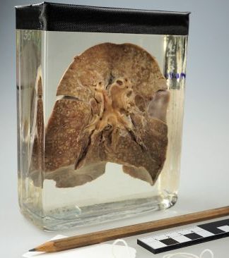 Kızamık Ne Zaman Ortaya Çıktı?